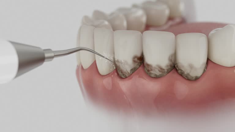 Trusted Wisdom Tooth Removal service in Cross Plains, TX - Dentist Open Now
